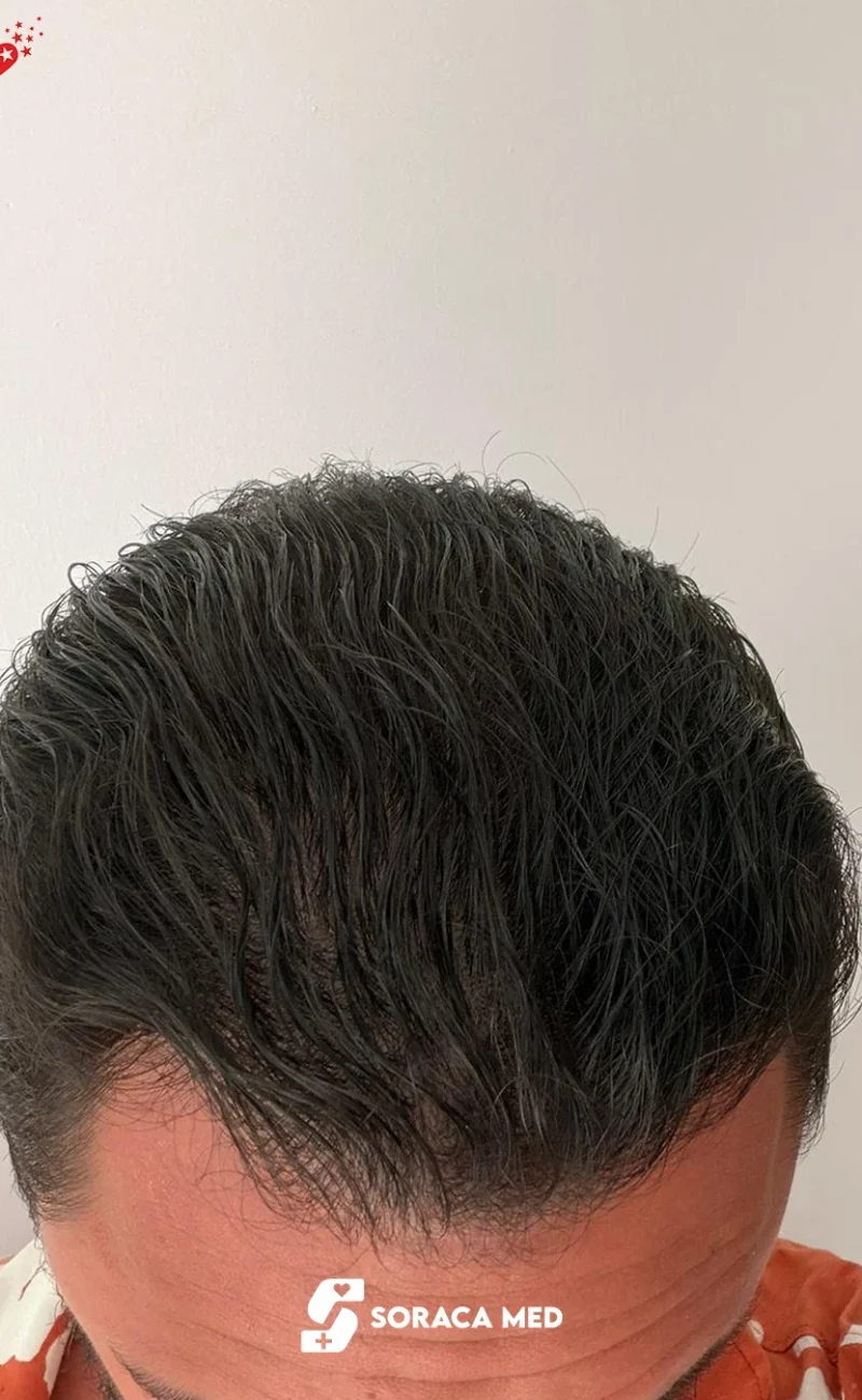 Soraca Med Hair Patients