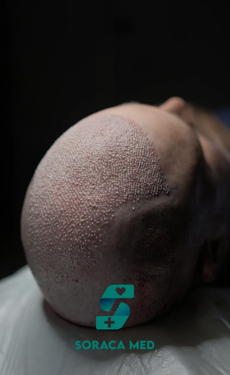 Soraca Med Hair Patients