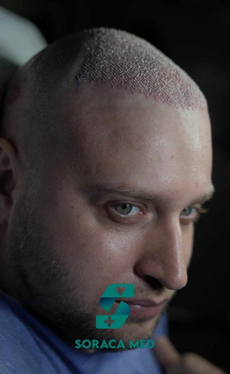 Soraca Med Hair Patients 2 (2)