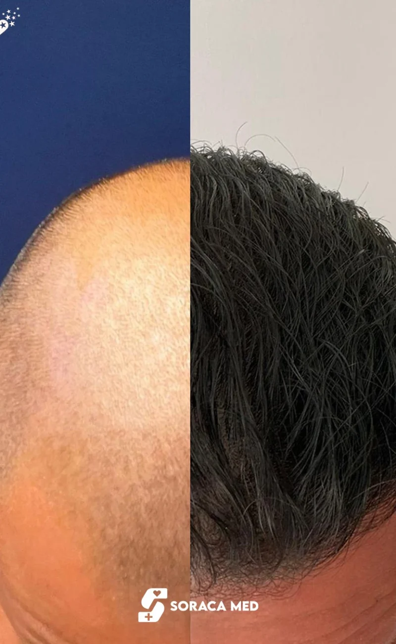 Soraca Med Hair Patients