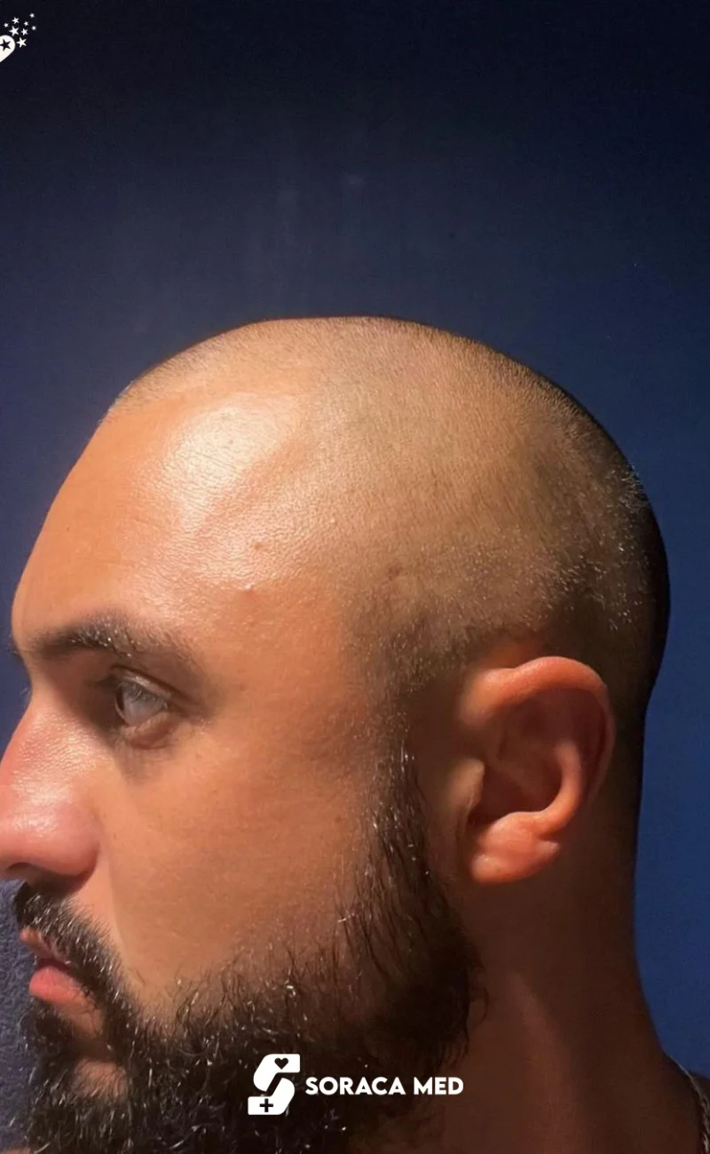Soraca Med Hair Patients