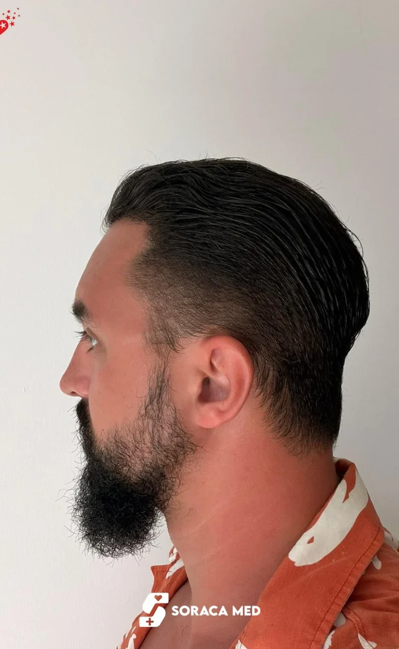 Soraca Med Hair Patients